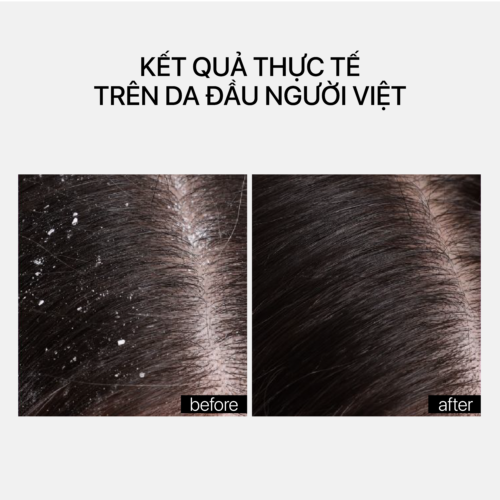 Alternative view of ANTI-DANDRUFF SCALP TREATMENT