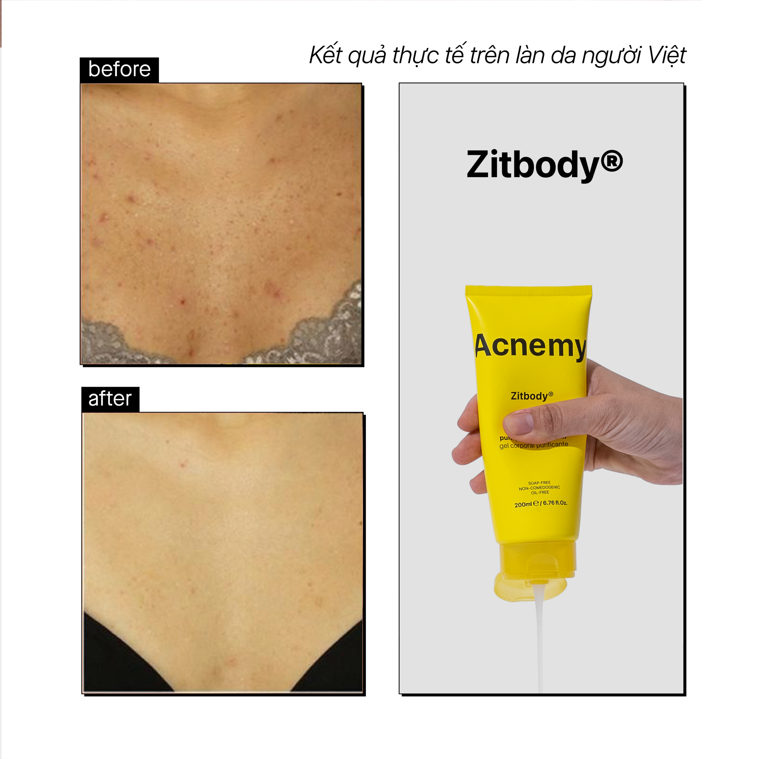 ZITBODY® POST BREAKOUT TREATMENT - Ảnh 6